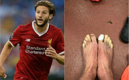 Así terminaron los pies de Lallana tras el Southampton-Liverpool Así terminaron los pies de Lallana tras el Southampton-Liverpool