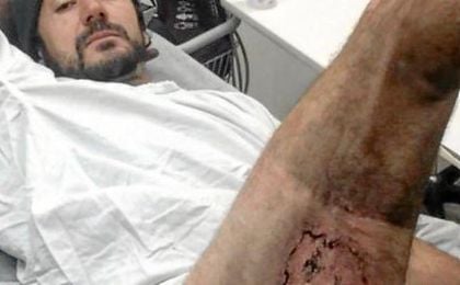 Gareth Clear compartió la foto de la quemadura tras explotar el iphone 6 que llevaba en el bolsillo. Gareth Clear compartió la foto de la quemadura tras explotar el iphone 6 que llevaba en el bolsillo.