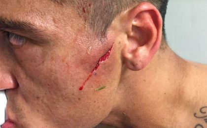 Así quedó la cara del ex del Betis Monzón tras sufrir esta espeluznante brecha Así quedó la cara del ex del Betis Monzón tras sufrir esta espeluznante brecha